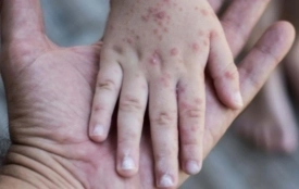 Сезонне загострення небезпечного вірусу Коксакі. Чи є він у Козятині?