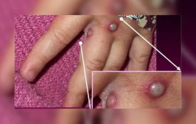 На Вінниччині зафіксували випадок віспи мавп у чоловіка: що варто знати про хворобу
